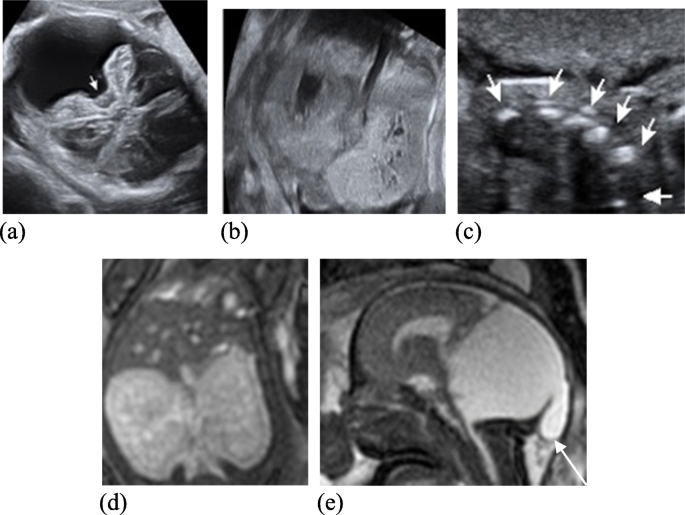 Use of MRI in the diagnosis of fetal brain abnormalities in utero  (MERIDIAN): a multicentre, prospective cohort study - The Lancet