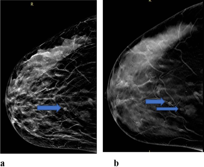 PDF] Three-Dimensional Imaging and Breast Measurements: How
