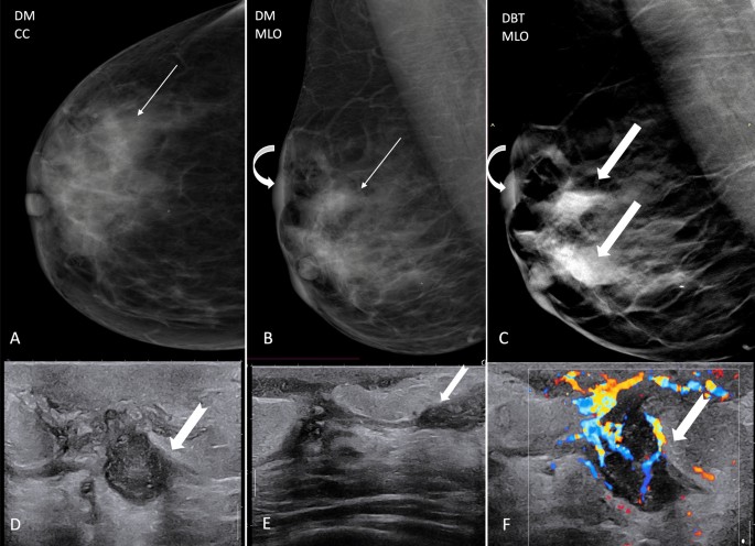 Performance evaluation of digital mammography, digital breast tomosynthesis  and ultrasound in the detection of breast cancer using pathology as gold  standard: an institutional experience, Egyptian Journal of Radiology and  Nuclear Medicine
