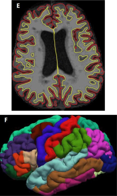 Results of whole brain analyses in the test scan. a The left parietal