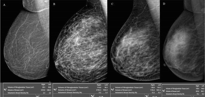 Do Dense Breasts Mean a Higher Risk of Breast Cancer? - Breast Cancer  Conqueror