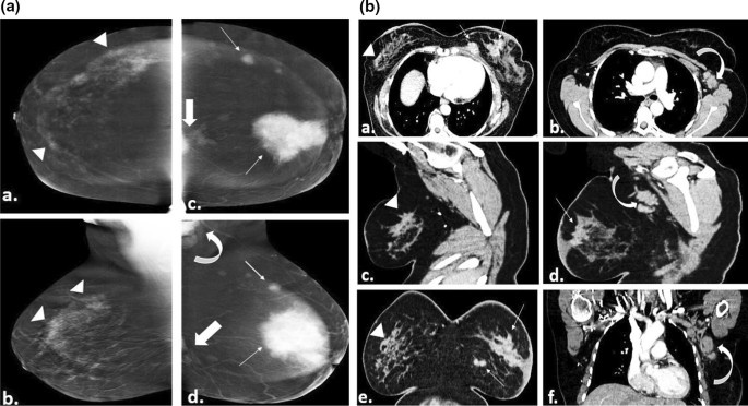 A 36-year-old patient with grade NOS II invasive breast cancer. A. The