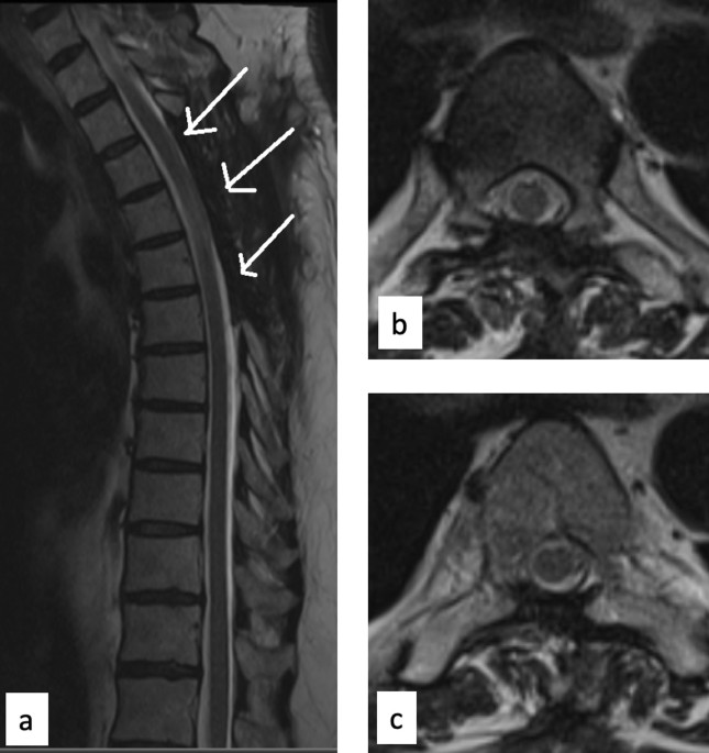Dorsal arachnoid web: the 'scalpel' sign—a case report and differential  diagnosis | Egyptian Journal of Radiology and Nuclear Medicine | Full Text
