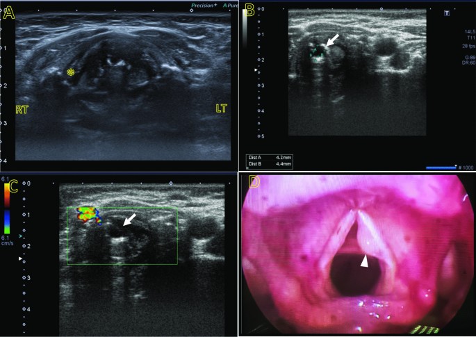 Value of laryngeal ultrasound in comparison with flexible laryngoscope in  diagnosis of various laryngeal masses: a cross-sectional study | Egyptian  Journal of Radiology and Nuclear Medicine | Full Text