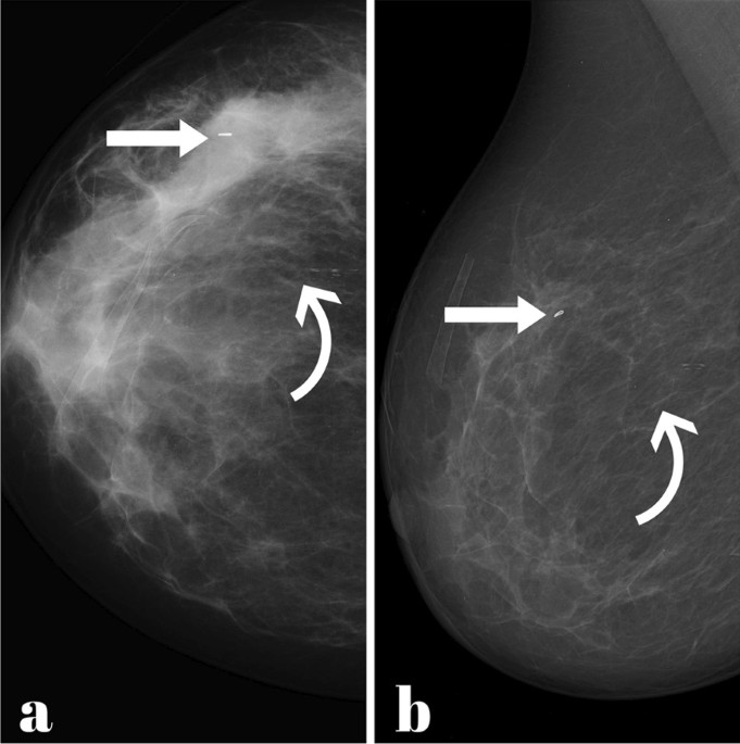 Ultrasound-guided percutaneous insertion of small vascular surgical clips  versus dedicated breast mammoclips as markers for breast cancer prior to  neo-adjuvant therapy: a prospective randomized controlled trial