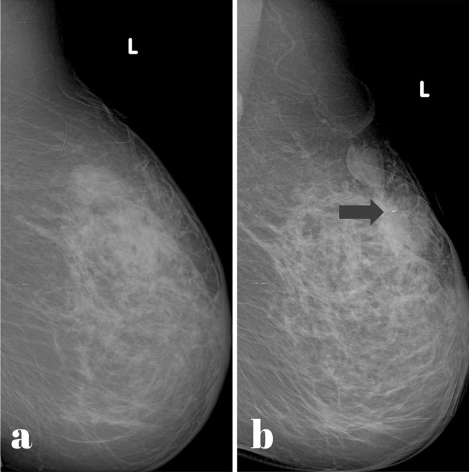 Accuracy Assessment of Surgical Clip Marker/Wire Localization in Advanced  Breast Cancer, Reports of Radiotherapy and Oncology