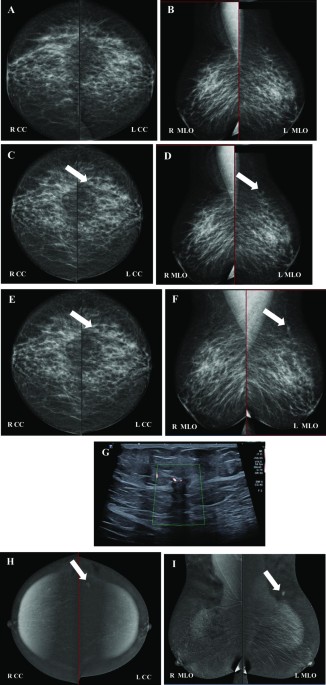 A Asymmetric breast enlargement within first trimester of pregnancy. B
