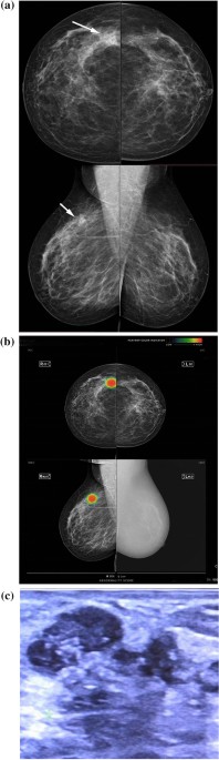 Mammographically detected asymmetries in the era of artificial