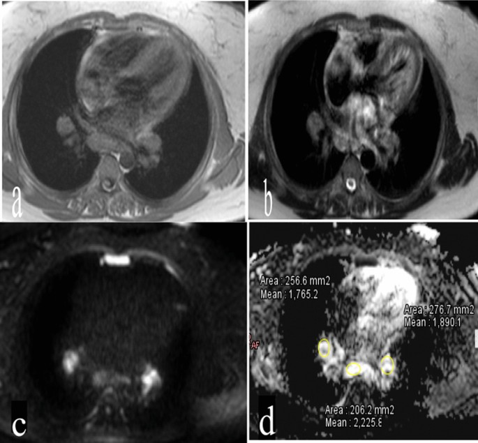Mediastinal lymphadenopathy in sarcoidosis: Can diffusion MRI play a role  in its evaluation? | Egyptian Journal of Radiology and Nuclear Medicine |  Full Text