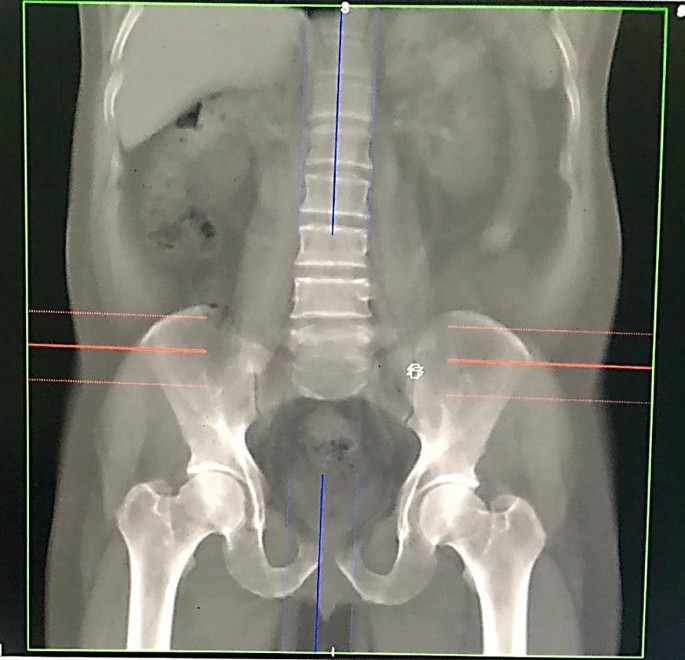 Computed tomography reference values estimation for femoral neck