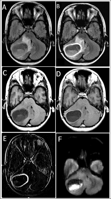 SciELO - Brasil - Inflammatory lesions and brain tumors: is it possible to  differentiate them based on texture features in magnetic resonance imaging?  Inflammatory lesions and brain tumors: is it possible to