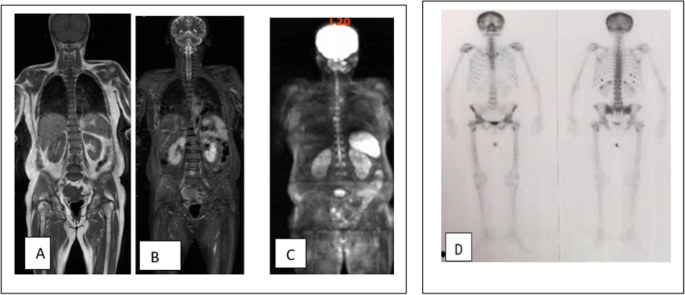 Diagnostic value of whole -body diffusion weighted imaging added to bone  scan in early diagnosis of bone metastases in breast cancer patients |  Egyptian Journal of Radiology and Nuclear Medicine | Full Text