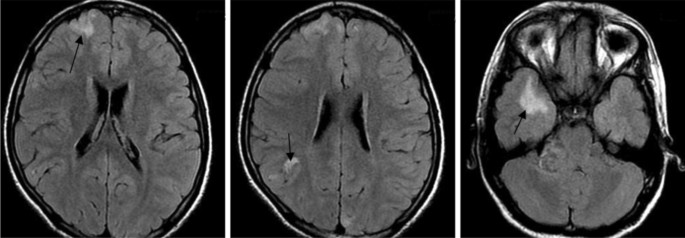 neurofibromatosis type 1 mri