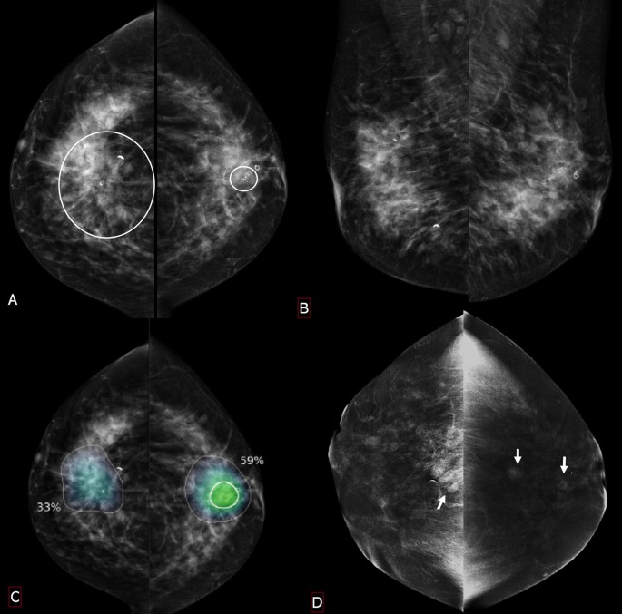 The integration of artificial intelligence with contrast-enhanced mammogram  in the work up of suspicious breast lesions: what do you expect?, Egyptian  Journal of Radiology and Nuclear Medicine