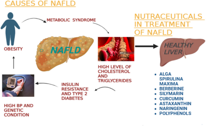 Role of natural compounds in non-alcoholic fatty liver diseases (NAFLD): a  mechanistic approach | Egyptian Liver Journal | Springer Nature Link