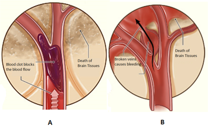 Cerebral ischemic stroke and different approaches for treatment of stroke |  Future Journal of Pharmaceutical Sciences | Springer Nature Link