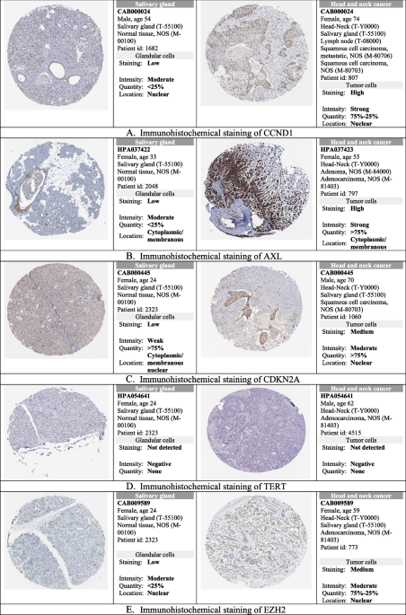 Studying the potential of upregulated PTGS2 and VEGF-C besides