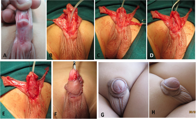 before and after topical l carnitine on penile glans Preoperative topical testosterone for penile hypospadias repair `a  comparative study` | Annals of Pediatric Surgery