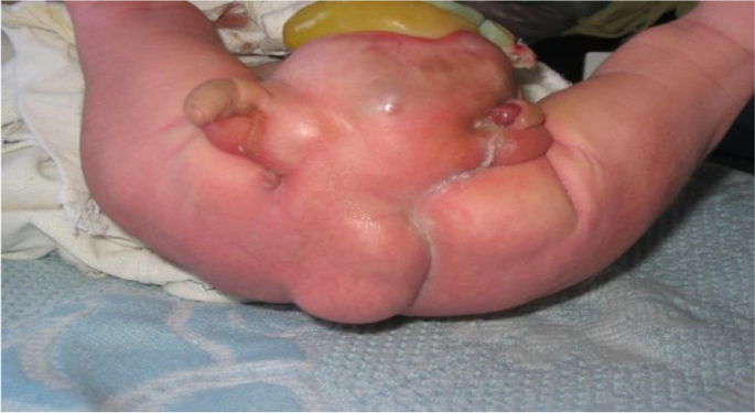 Complete diphallia associated with unusual multiple congenital anomalies:  case report and review of literatures | Annals of Pediatric Surgery | Full  Text