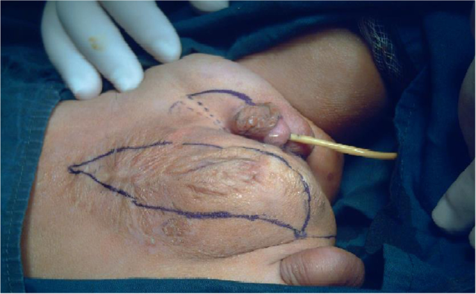 Complete diphallia associated with unusual multiple congenital anomalies:  case report and review of literatures | Annals of Pediatric Surgery | Full  Text