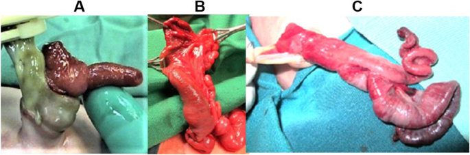 Picture of umbilical cord hernia associated with complete evagination