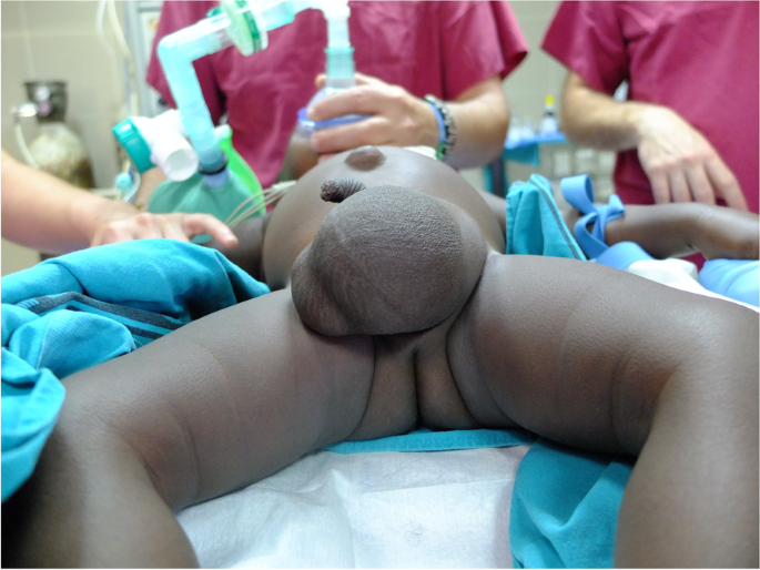 Analyzing complications and implementing solutions in a pediatric inguinal  hernia cooperation program in Equatorial Guinea: a prospective cohort study, Annals of Pediatric Surgery