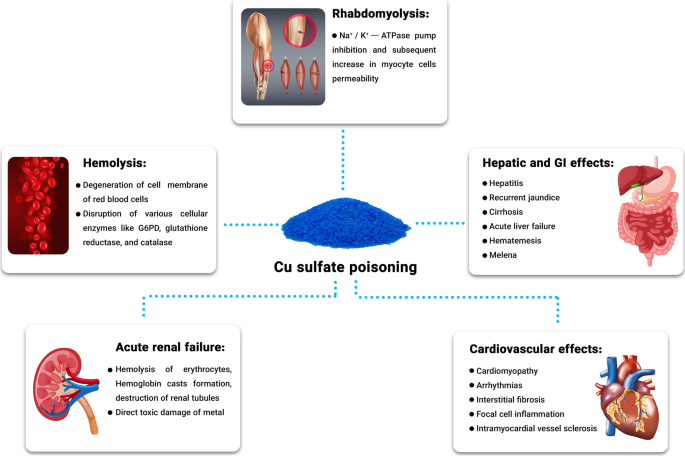 Acute poisoning of copper sulfate: a case report and review literature |  The Egyptian Journal of Internal Medicine