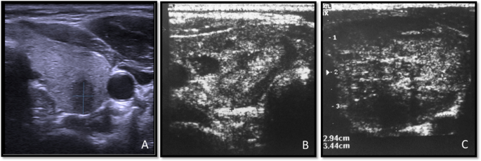 Correlation of ultrasound features in the TIRADS scoring system with  cytological findings in the FNAC of thyroid nodules and their association  with the metabolic status, The Egyptian Journal of Internal Medicine