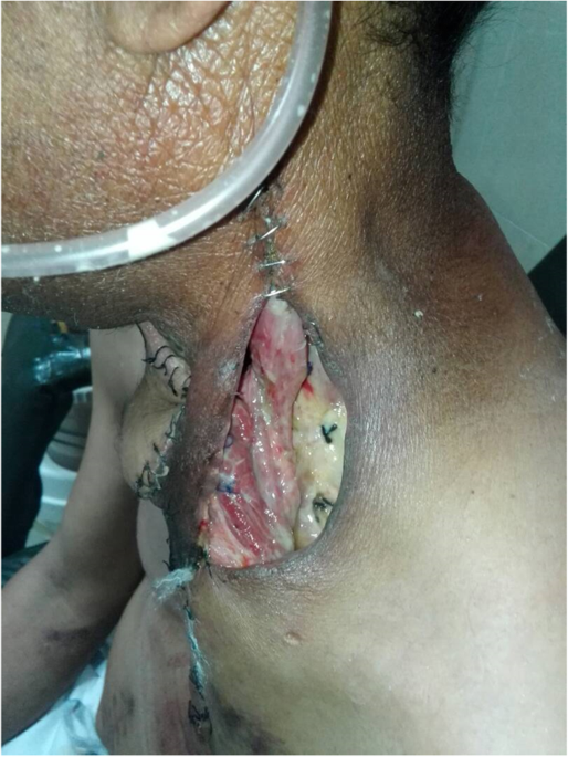 Internal jugular vein rupture after oncologic resections in the head and  neck | The Egyptian Journal of Otolaryngology | Full Text