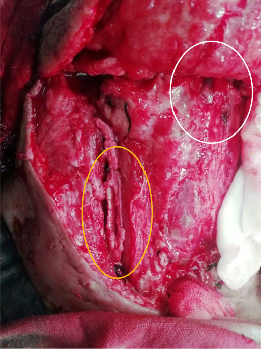 Internal jugular vein rupture after oncologic resections in the head and  neck | The Egyptian Journal of Otolaryngology | Full Text