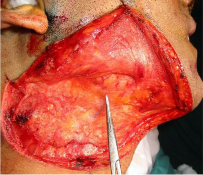 Marginal Mandibular Nerve Weakness (Ramus Mandibularis) - Level I Neck  Dissection (extended) recurrent pleomorphic adenoma - Clinical case example