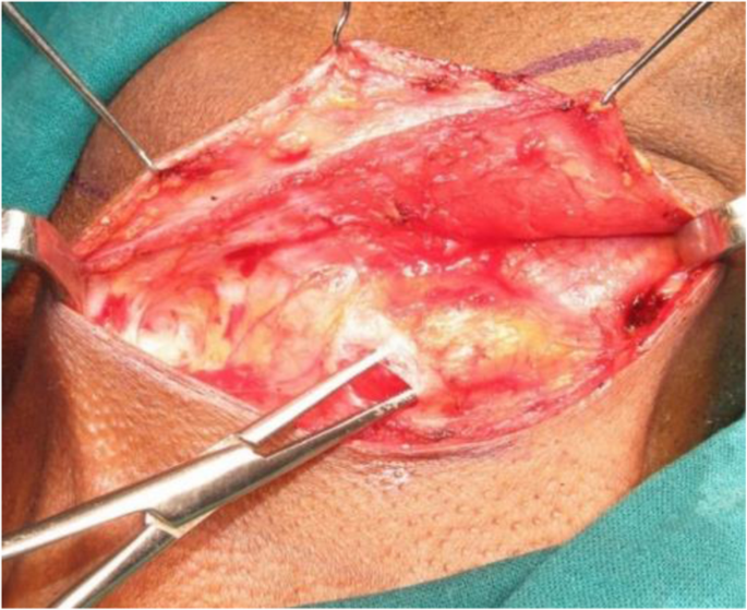 Marginal Mandibular Nerve Weakness (Ramus Mandibularis) - Level I Neck  Dissection (extended) recurrent pleomorphic adenoma - Clinical case example