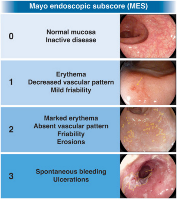 Evaluation of subclinical pulmonary involvement in inflammatory bowel disease using spirometry: an observational study