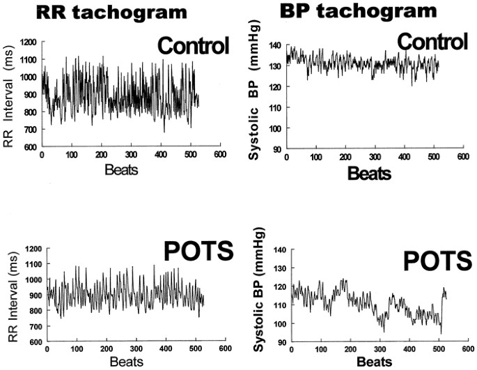 Postural Orthostatic Tachycardia, Heart Health