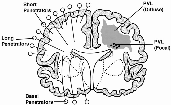 Neurobiology Of Periventricular Leukomalacia In The Premature Infant Pediatric Research