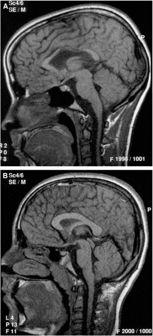 Caudate and hippocampal volumes, intelligence, and motor impairment in 7-year-old children who were born preterm