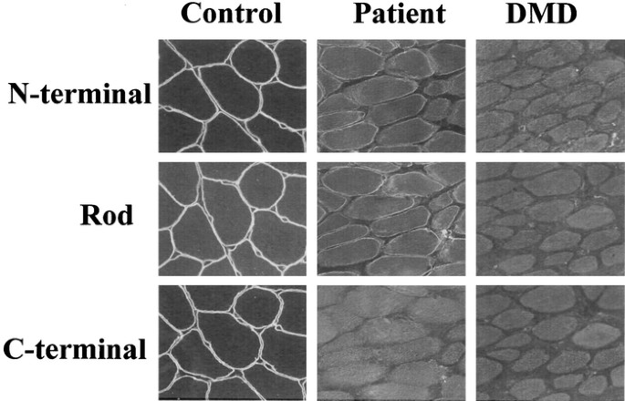 C-Terminal Truncated Dystrophin Identified in Skeletal Muscle of an Asymptomatic Boy with a Novel Nonsense Mutation of the Dystrophin Gene