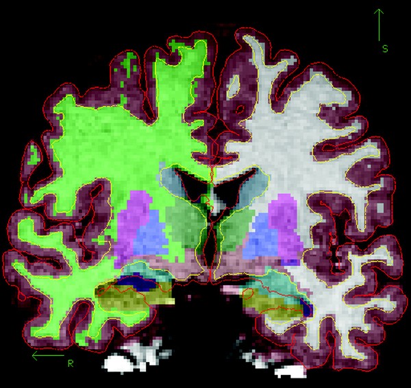 The Effect Of Early Human Diet On Caudate Volumes And Iq Pediatric Research