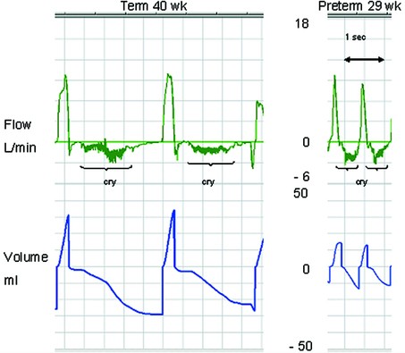 Breathing Patterns in Preterm and Term Infants Immediately After Birth
