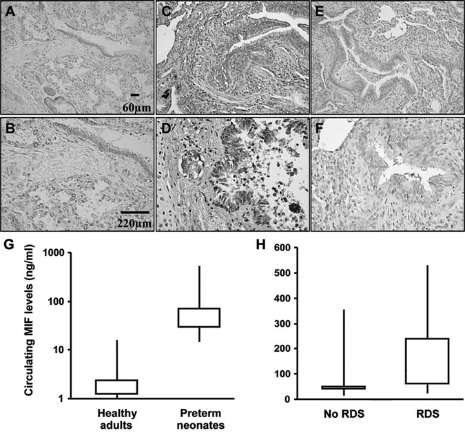 A polymorphism in the macrophage migration inhibitory factor promoter is associated with bronchopulmonary dysplasia