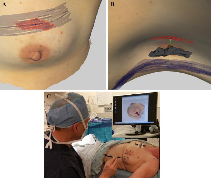 A Randomized Prospective Trial of Supine MRI-Guided Versus Wire-Localized  Lumpectomy for Breast Cancer | Annals of Surgical Oncology