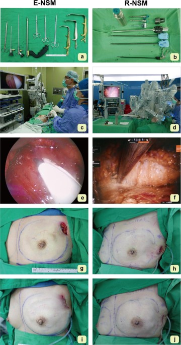 Robotic- Versus Endoscopic-Assisted Nipple-Sparing Mastectomy with  Immediate Prosthesis Breast Reconstruction in the Management of Breast  Cancer: A Case–Control Comparison Study with Analysis of Clinical Outcomes,  Learning Curve, Patient-Reported