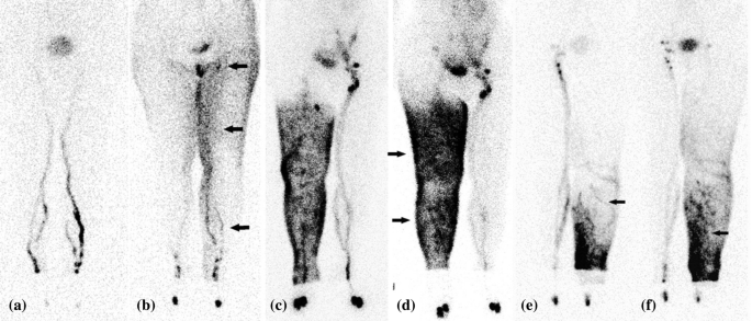 A new severity classification of lower limb secondary lymphedema
