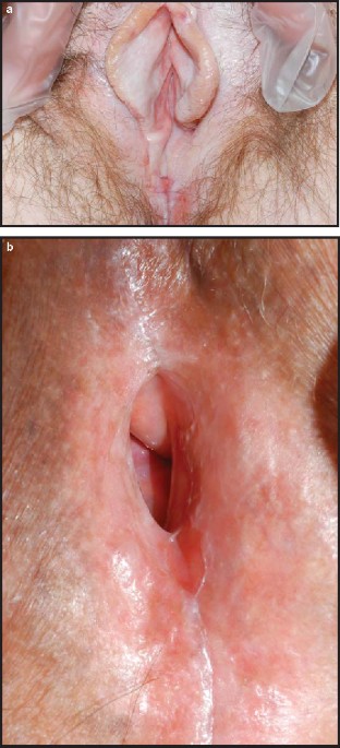 Vulvar Lichen Sclerosus in the Elderly | Drugs & Aging