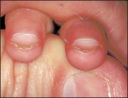 melanotic whitlow What Is an Acquired Melanocytic Nevus? Vitiligo: Causes, Classification, and Treatment