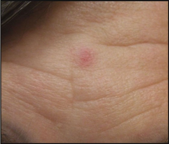 Cutaneous Disorders of the Breast