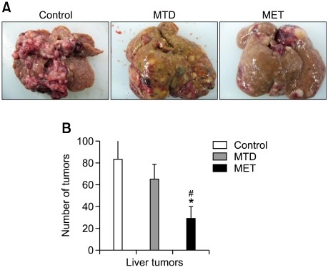 cancer hepatic treatment