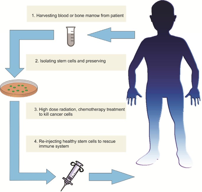 National Cancer Institute - What are bone marrow transplantation and  peripheral blood stem cell transplantation? These procedures restore stem  cells that have been destroyed by high doses of chemotherapy and/or  radiation therapy