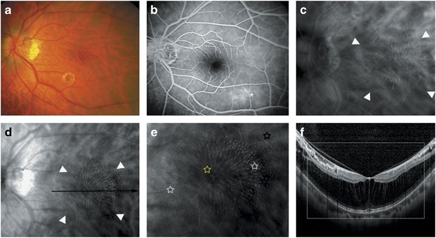 The noninvasive retromode imaging of confocal scanning