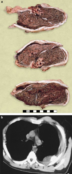 Sarcomatoid mesothelioma: a clinical-pathologic ...